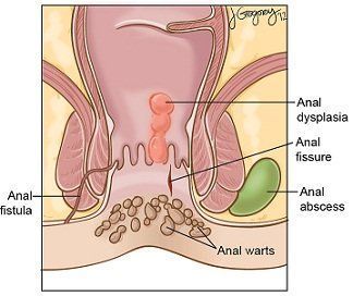 Anal Thrombosis - Cure growths around anus . XXX Sex Photos.