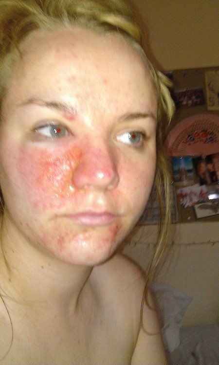 Right Facial Cellulitis Nude Pics Comments